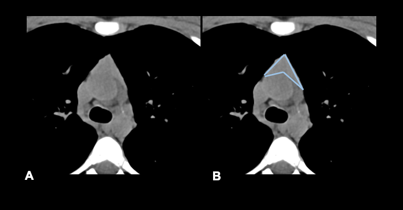 Fig 2 Non-contrast CT in a young patient, showing the normal configuration of th.gif